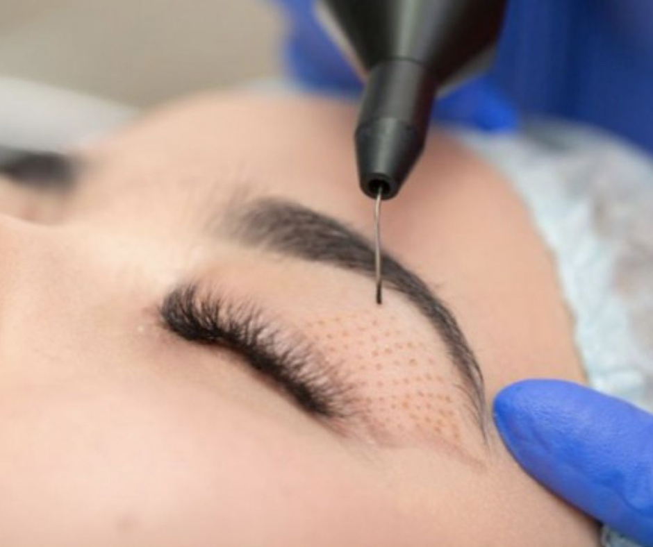 Fibroblastia (Plasma Pen)